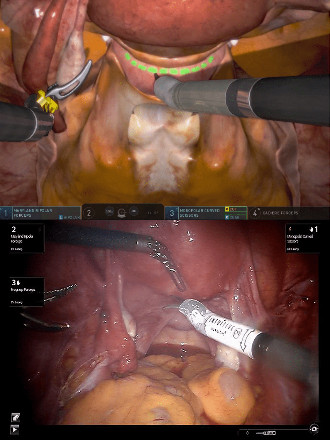 3D Systems Hysterectomy